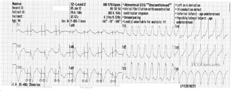 V Tach | ECG Guru - Instructor Resources