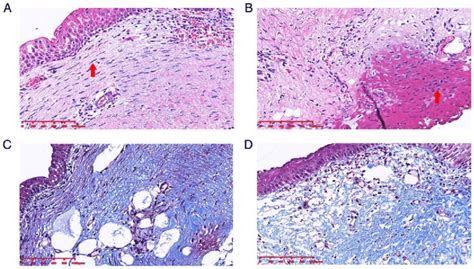 Histopathological Assessment Of Biopsies Of Hyperplasia Of Fibrous