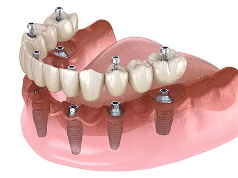 All On 6 Implant Services Elite Dental Lab