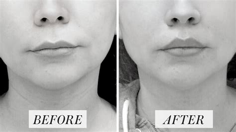 Short Philtrum Lip Filler - Infoupdate.org