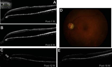 Photographs Of The Left Eye After Vitrectomy A Optical Coherence Download Scientific Diagram