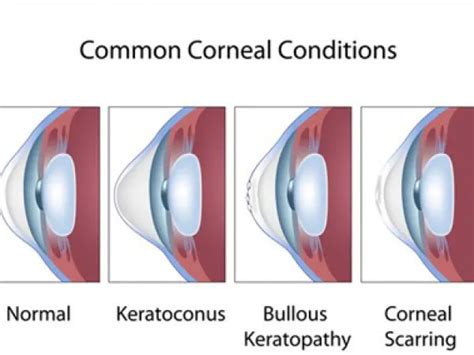 Cornea Transplant Surgery Keratoconus Treatment Cost