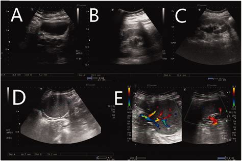 Ultrasound And Color Doppler Sonographic Images A Calculus In The Download Scientific Diagram