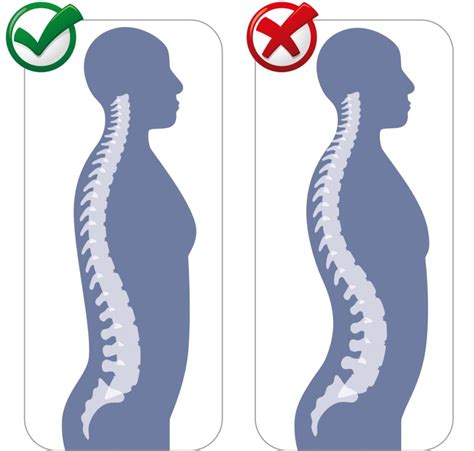 Qu Es Y C Mo Prevenir La Hiperlordosis Lumbar Con S De Sport