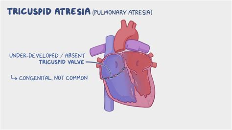 Tricuspid atresia: Nursing - Osmosis Video Library