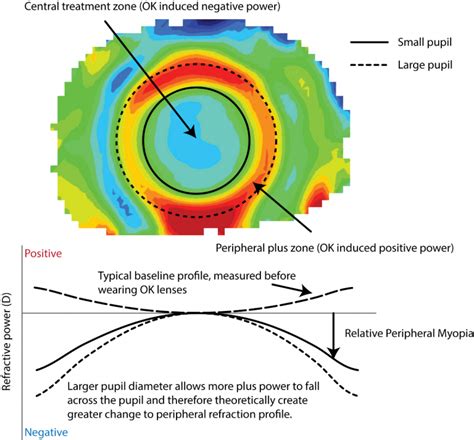 Customizing Orthokeratology For Myopia Control Contact Lens Update