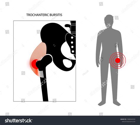 Trochanteric Bursitis Inflammation Inflamed Royalty Free Stock