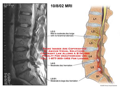 Amicus Illustration Of Amicus Radiology Mri Lumbar Disc Bulge