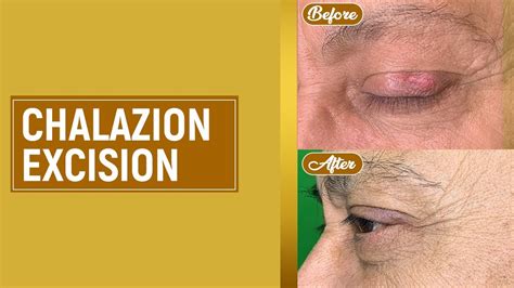 Chalazion Removal Excision Procedure Before And After Eyelid Cyst