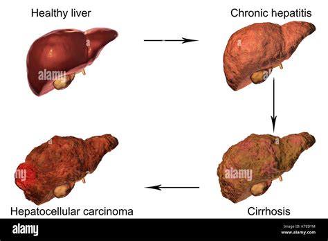 Hígado humano mostrando las etapas de la enfermedad hepática equipo de