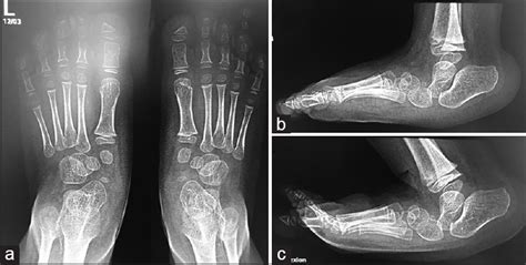 isolated congenital vertical talus genetics  genomics journal