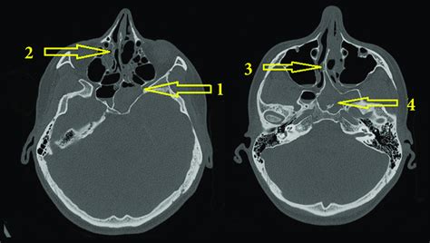 Computed Tomography Of The Head Showing A Chronic Inflammatory Download Scientific Diagram