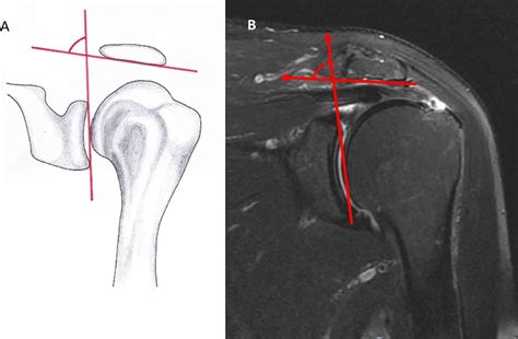 Relationship Between The Critical Shoulder Angle And Shoulde Jbjs