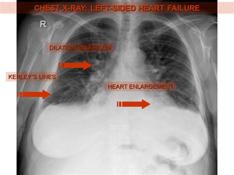 Chest X Ray Pleural Effusion