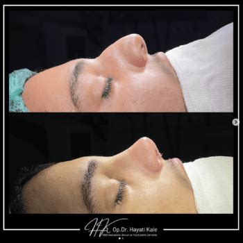 Piezo Ultrasonic Rhinoplasty Dr Hayati Kale