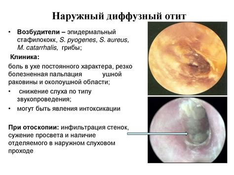 5.-Zabolevaniya-naruzhnogo-ukha_-ostryy-otit_-mastoidit - online ...