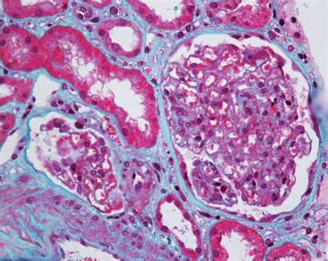 Light Microscopy Showing Eosinophilic Complexes In The Mesangial And