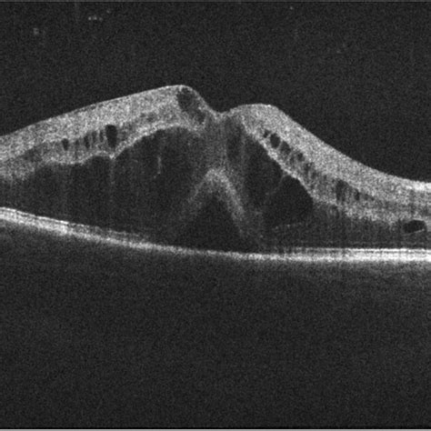 Oct Showing A Cystoid Macular Edema And A Serous Neuroretinal