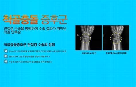 마디사랑병원 수술치료 손목수술 척골 충돌 증후군