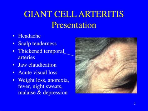 PPT GIANT CELL ARTERITIS Temporal Or Cranial Arteritis PowerPoint