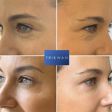 Brow Lift Trikwan Aesthetics Treatment For Brow Re Shaping London