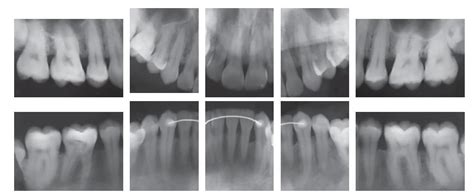 Scielo Brasil Orthodontic Treatment As An Adjunct To Periodontal