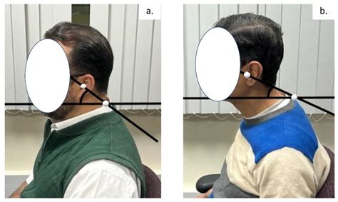 Jcm Free Full Text Does Forward Head Posture Influence Somatosensory Evoked Potentials And