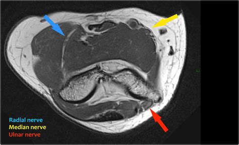 How to Read a Hip Mri Arthrogram - Wilder Ateres