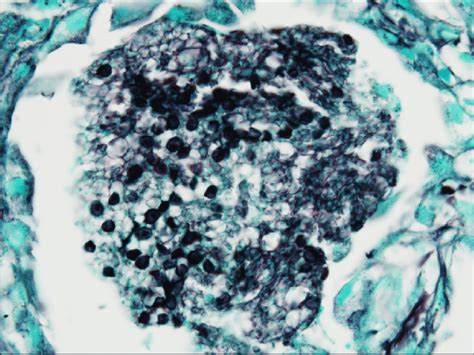 Gomori Methenamine Silver Gms Stain Of Transbronchial Biopsy Shows Download Scientific