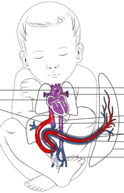 Congenital Heart Disease Diagram | Quizlet