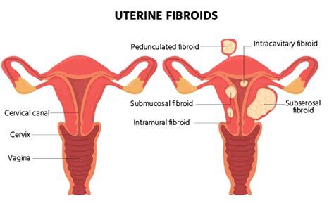 Myomectomy Indications Lifestyle Changes Recovery