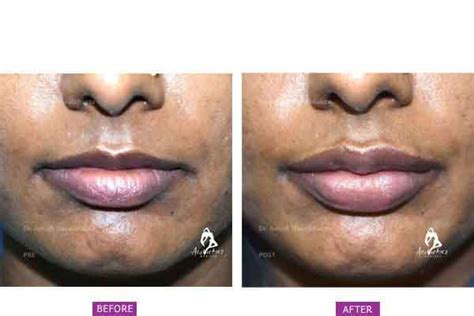 Perfect Your Lips with Lip Surgery | Dr. Ashish Davalbhakta, Pune