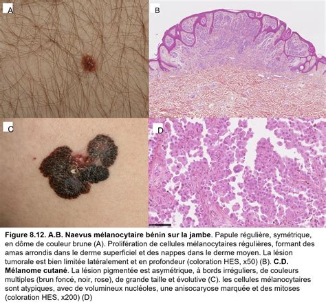 Société Française de Pathologie 8 Tumeurs non épithéliales