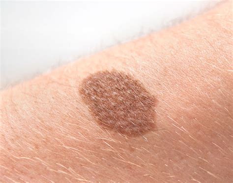 Tips To Check Your Skin For Common W Signs Of Skin Cancer Uk