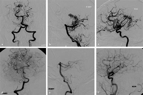 29 Endovascular Management Of Brainstem And Thalamic Arteriovenous Malformations Neupsy Key