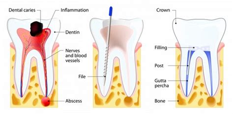 Endodontologie Wurzelbehandlung Zahnarzt Luzern Zahnarztpraxis