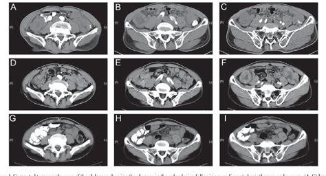 Figure 1 From Gemcitabine Based Chemotherapy In Colon Squamous Cell