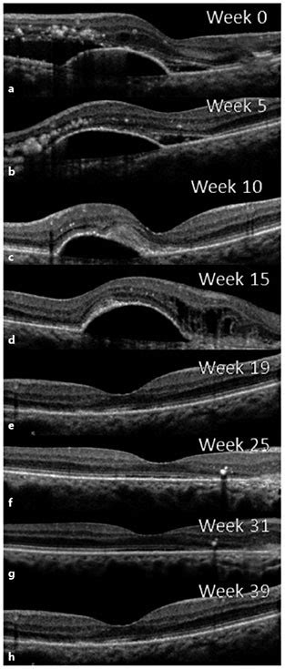 Macular OCT demonstrating subfoveal fluid and pigment epithelial... | Download Scientific Diagram