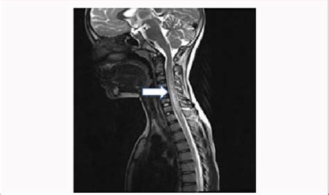 MRI spine showing hyperintensities extending from C2-D6 segment of ...