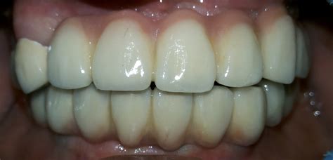 Full Mouth Dental Implant Cases In Ahmedabad Dental Implants Before After