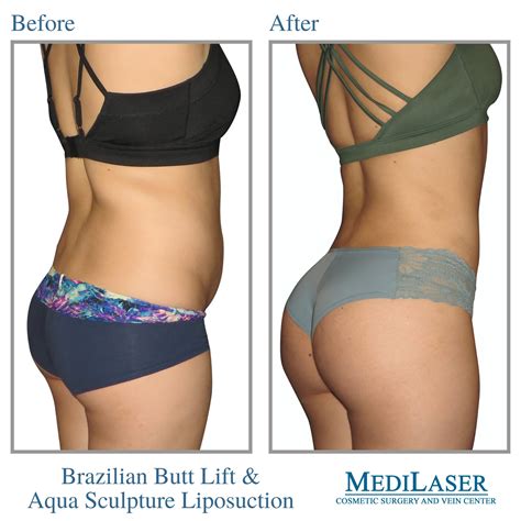 Brazilian Butt Lift Before And After Medilaser Surgery And Vein Center