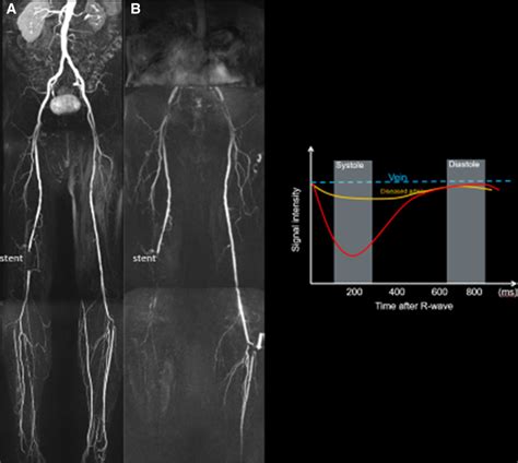 Noncontrast Magnetic Resonance Angiography For The Diagnosis Of