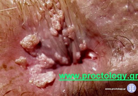 Anal Warts Hpv Athens Greece Colorectal Gr