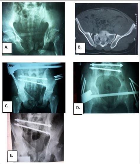 A B Non Displaced Left Denis Ii Sacral Fracture With Right Anterior Download Scientific