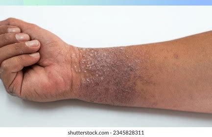 5 216 Person Atopic Dermatitis Images Stock Photos 3D Objects