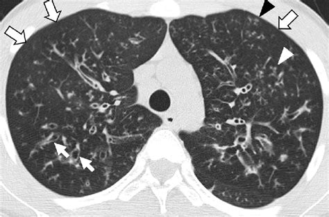 Cystic Fibrosis In 15 Year Old Male Patient Who Underwent Lung Download Scientific Diagram