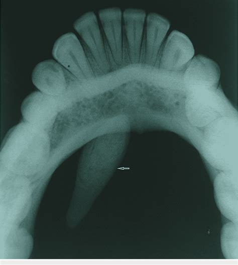 Figure 2 From Sialolith Of Unusual Size And Shape In The Anterior