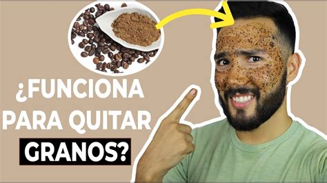 Remedio Casero Para Quitar Granos Funciona Inspira Tu Estilo YouTube