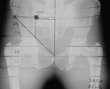 'Anode heel effect' on patient dose in lumbar spine radiography (PDF ...