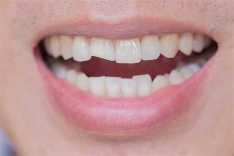 What To Do With A Chipped Tooth Tooth Repair At Exquisite Dentistry